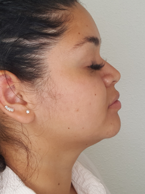 Female Side Face Before Kybella Treatment in Bonney Lake, WA | Honey Glow Health,