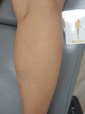 Before Sclerotherapy treatment | Honey Glow Health in Bonney Lake, WA