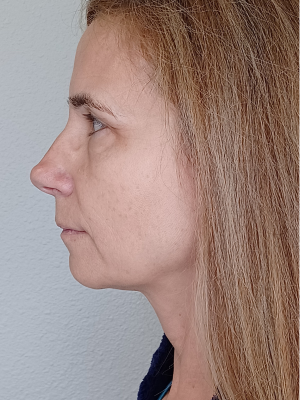 Before Laser treatment portrait of woman| Honey Glow Health in Bonney Lake, WA