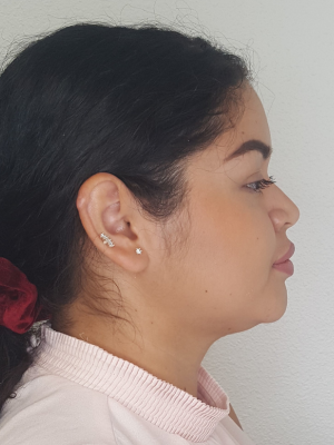 Female Side Face After Kybella Treatment in Bonney Lake, WA | Honey Glow Health,