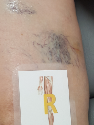 Before Sclerotherapy treatment | Honey Glow Health in Bonney Lake, WA