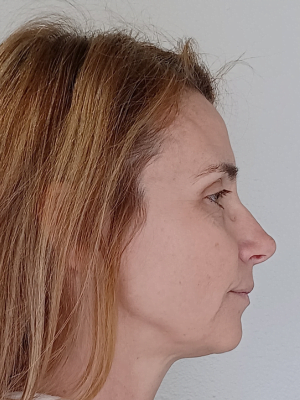 After Laser treatment results on Woman | Honey Glow Health in Bonney Lake, WA After Laser treatment results on Woman | Honey Glow Health in Bonney Lake, WA