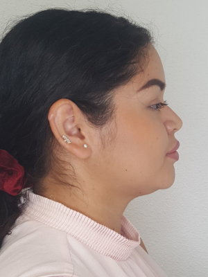 Female Side Face After Kybella Treatment in Bonney Lake, WA | Honey Glow Health