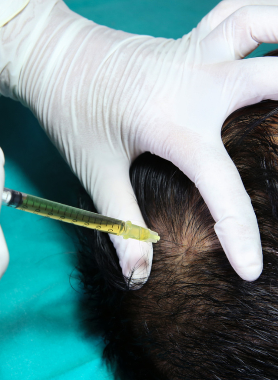 Aesthetician Giving Hair Restoration Injection on Men's Scalp | Honey Glow Health in Bonney Lake, WA