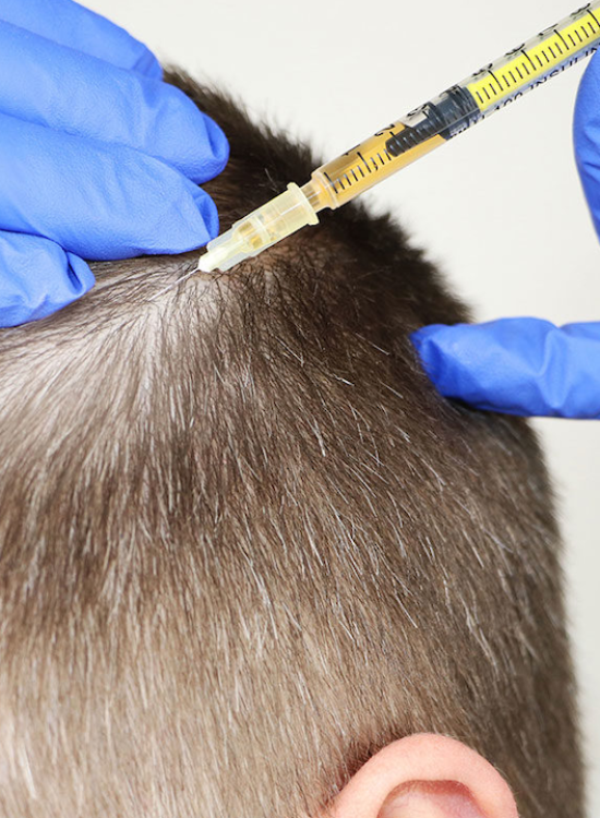 Esthetician Giving Hair Restoration Injection on Men's Scalp | Honey Glow Health in Bonney Lake, WA