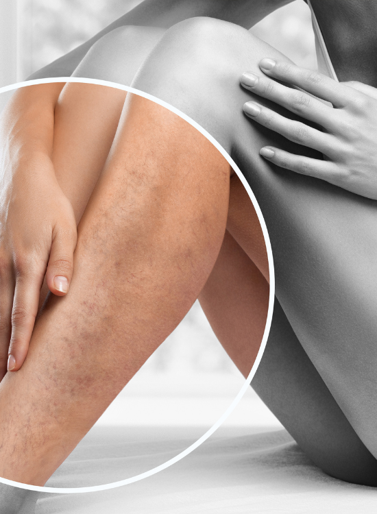 A portrait showing spotting a woman's leg for veins | Sclerotherapy in Honey Glow Health | Bonney Lake, WA