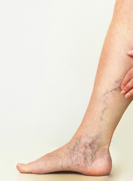 A portrait showing Women's leg having varicose veins | Sclerotherapy in Honey Glow Health | Bonney Lake, WA