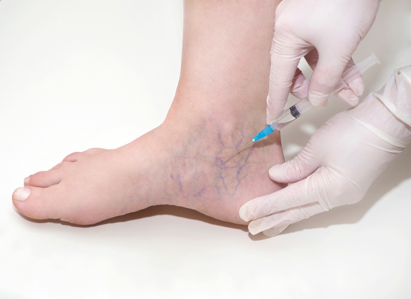 Does Sclerotherapy Remove Leg Veins Permanently